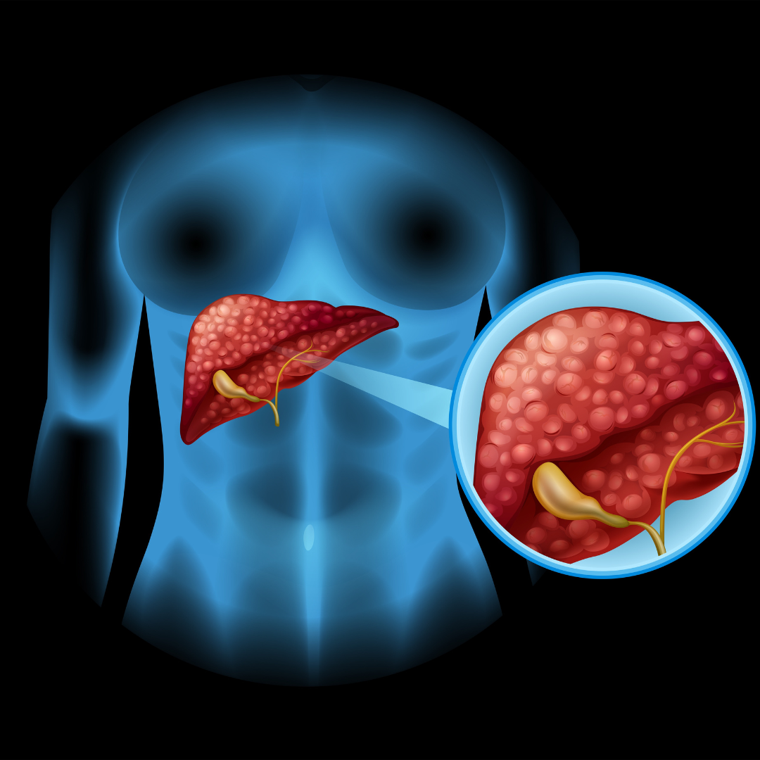 Liver Disease